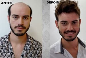 protese-capilar-masculina