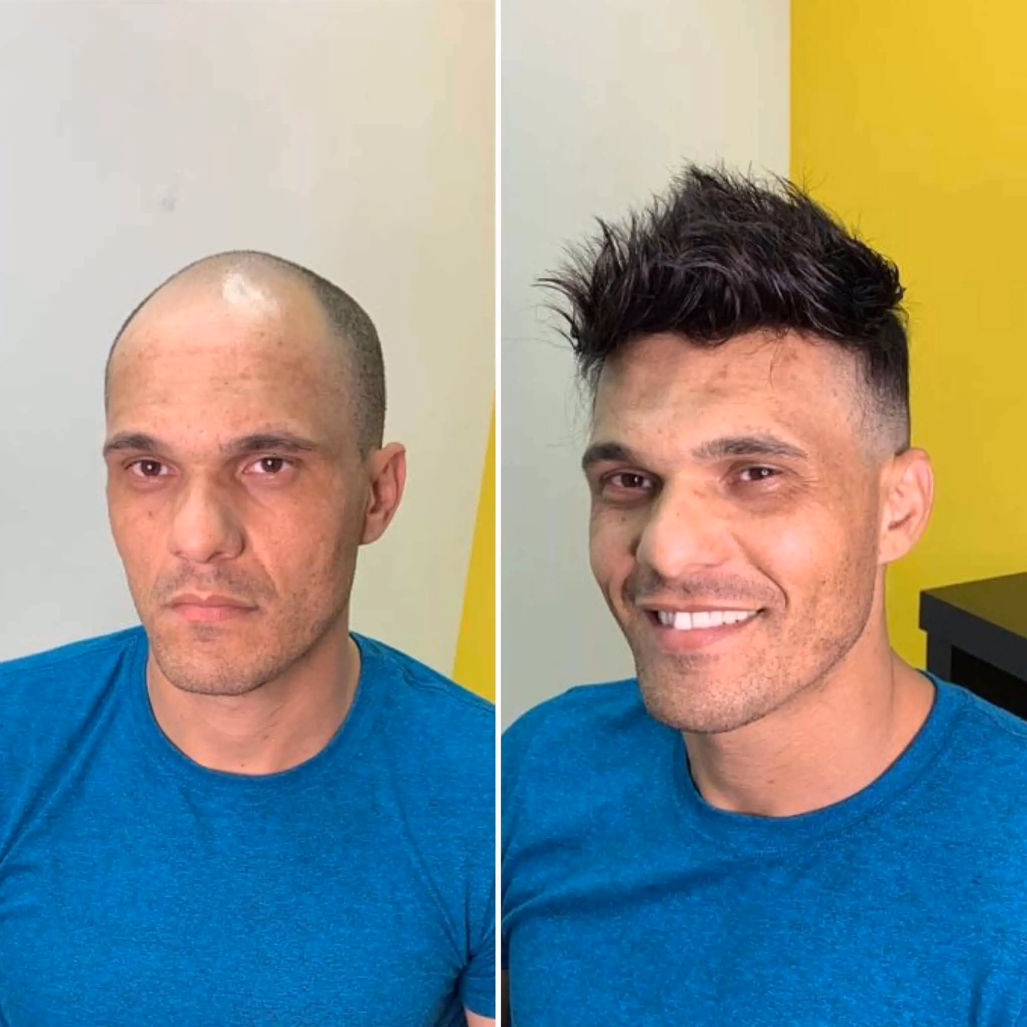 protese-capilar-masculina